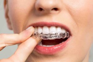 Aligner Therapie – Alles, was Sie zur unsichtbaren Zahnschiene wissen sollten