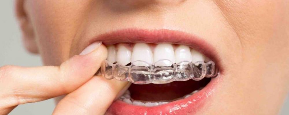 Aligner Therapie Die Unsichtbare Zahnschiene Alle Infos