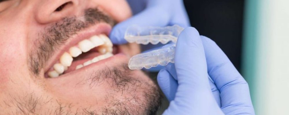 Behandlungsablauf Bei Einer Invisalign C Zahnspange In Osterreich