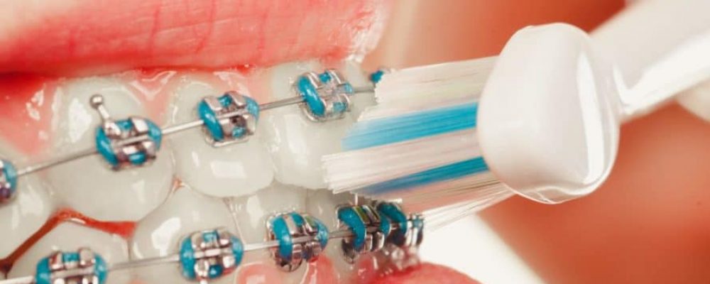 Brackets - Die Zahnspange für Kinder & Erwachsene